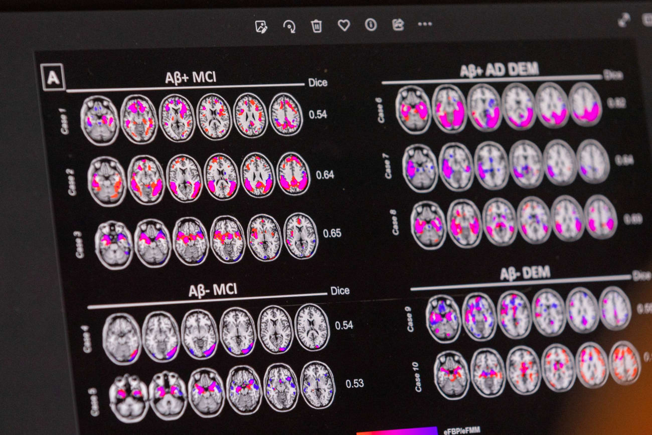 A scientist looks at hypometabolic and hypoperfusion patterns at the single-subject level from a patient with Alzheimer's disease at the Memory Centre, in Geneva, Switzerland, on June 6, 2023. 