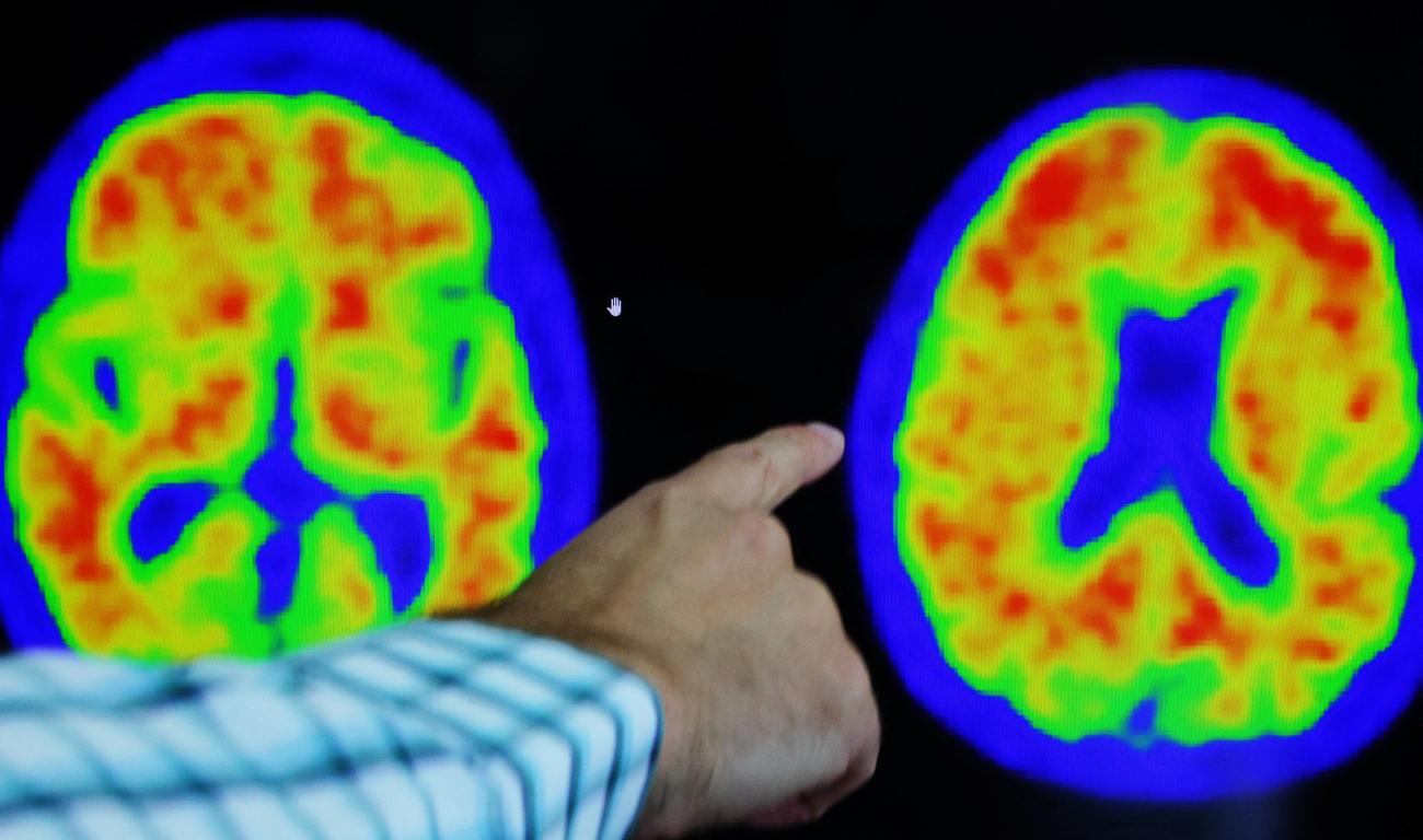 Dr. Seth Gale points out evidence of Alzheimer's disease on PET scans at the Center for Alzheimer Research and Treatment (CART) at Brigham and Women's Hospital in Boston, Massachusetts, on March 30, 2023.