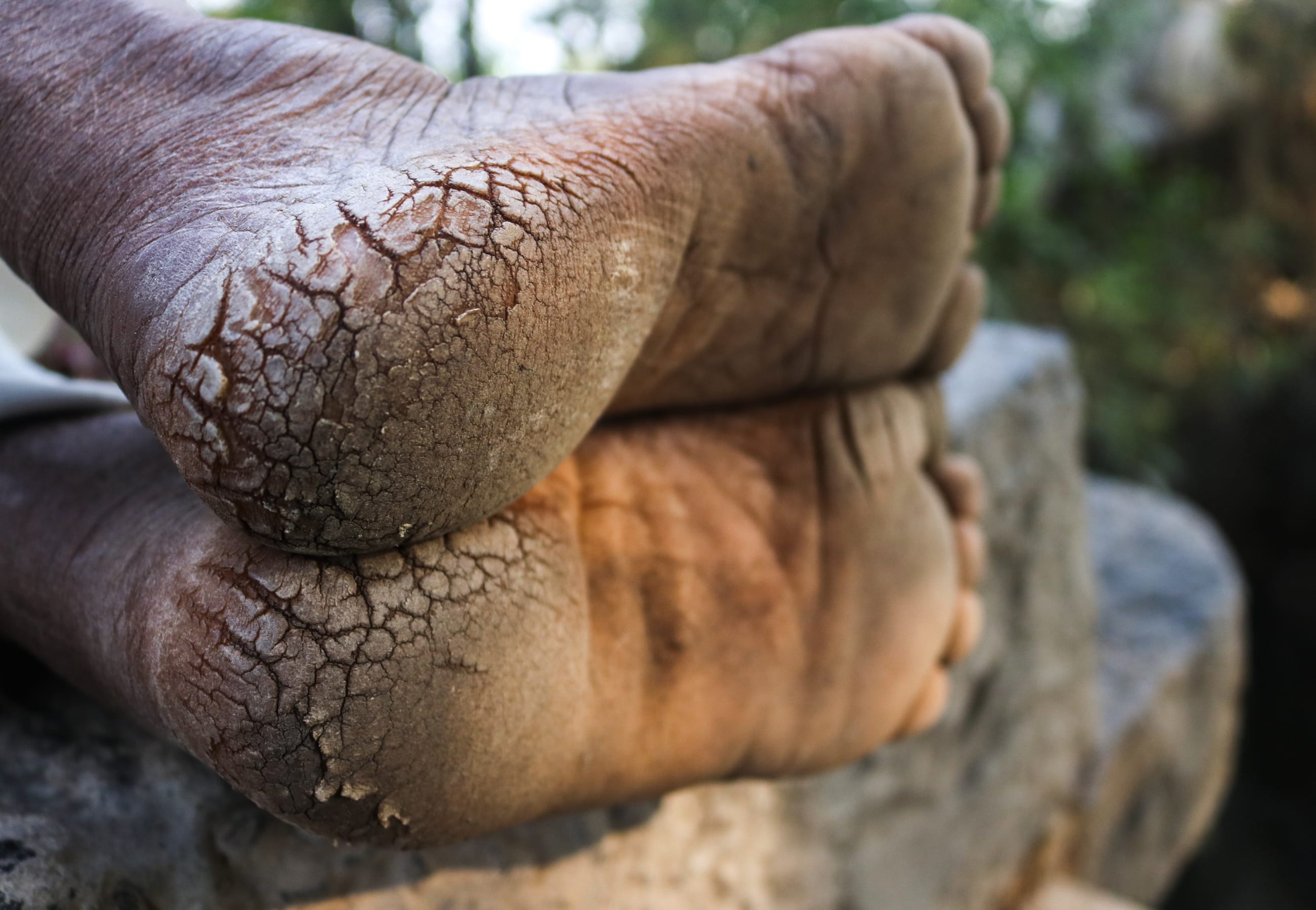 A worker's feet are shown with cracked heels.