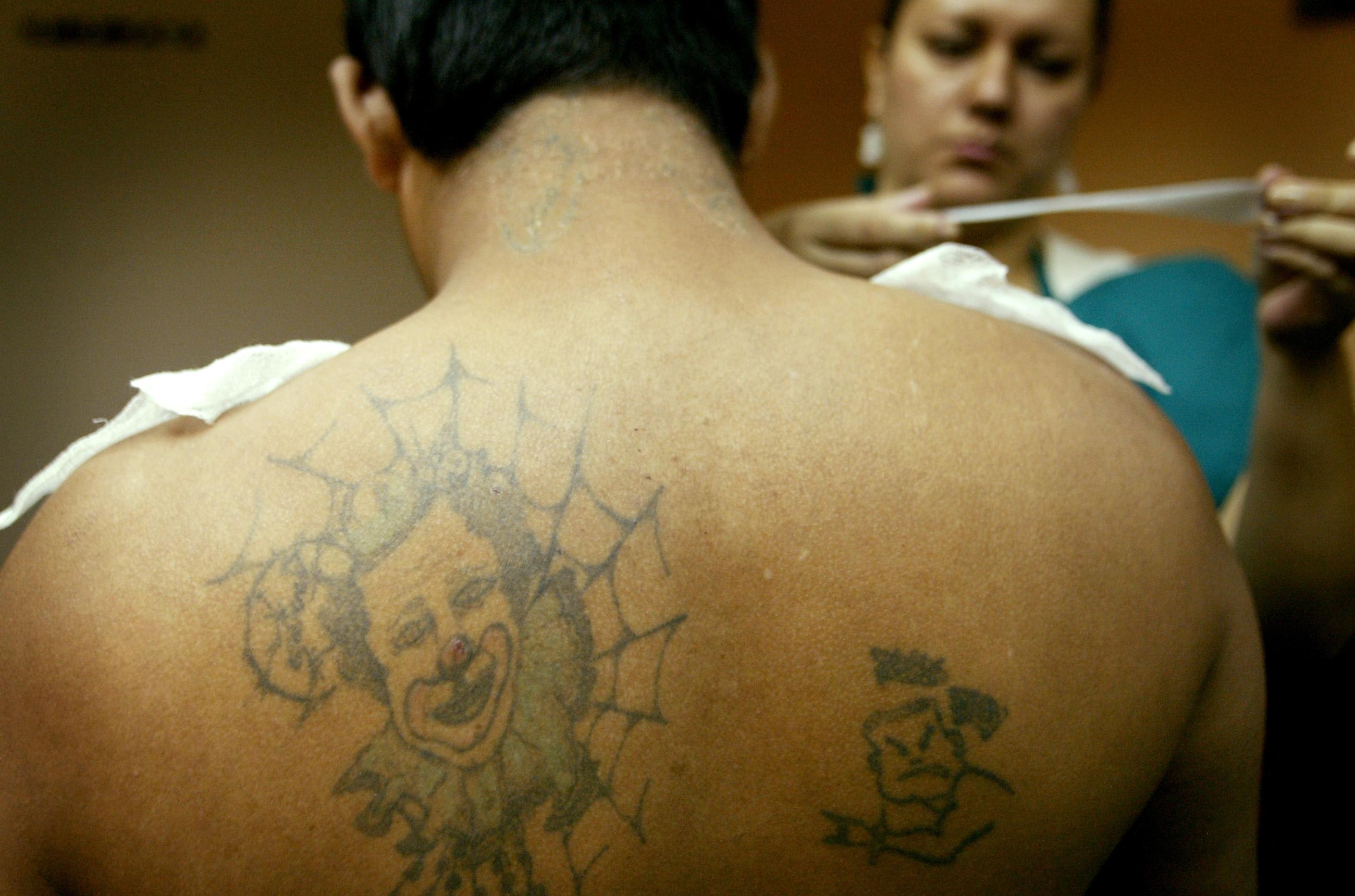 A nurse prepares a gang member of the Mara Salvatrucha for laser removal of a tattoo in San Salvador, El Salvador, June 26, 2007.