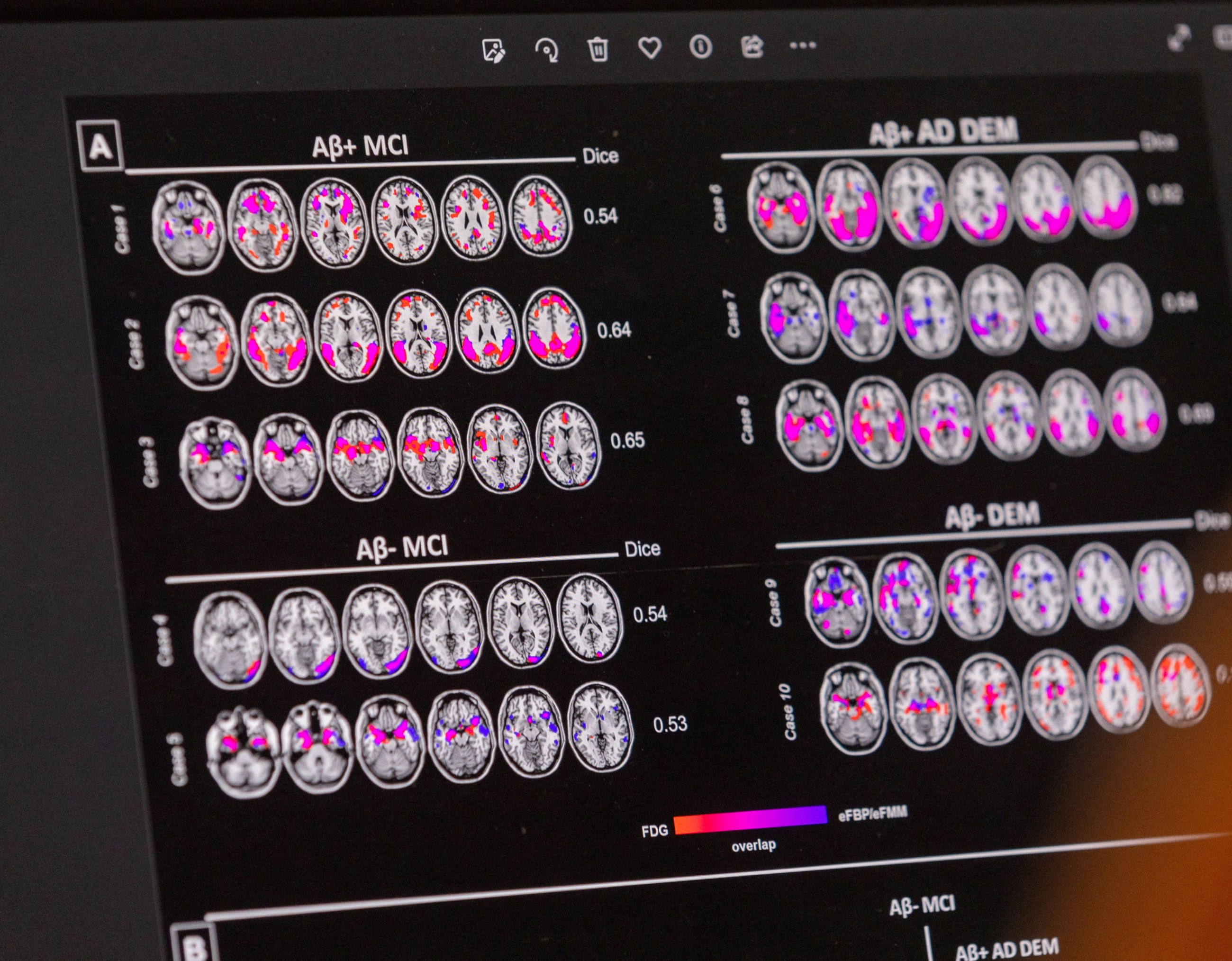 A scientist looks at hypometabolic and hypoperfusion patterns at the single-subject level from a patient with Alzheimer's disease at the Memory Centre, in Geneva, Switzerland, on June 6, 2023. 