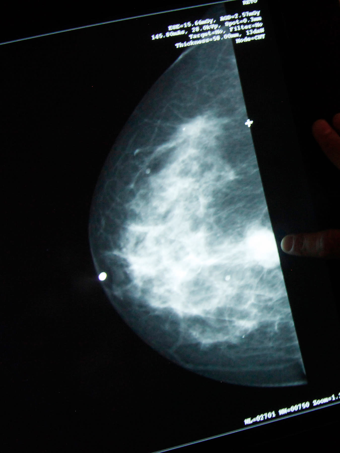 The photo shows an X-ray of a breast.