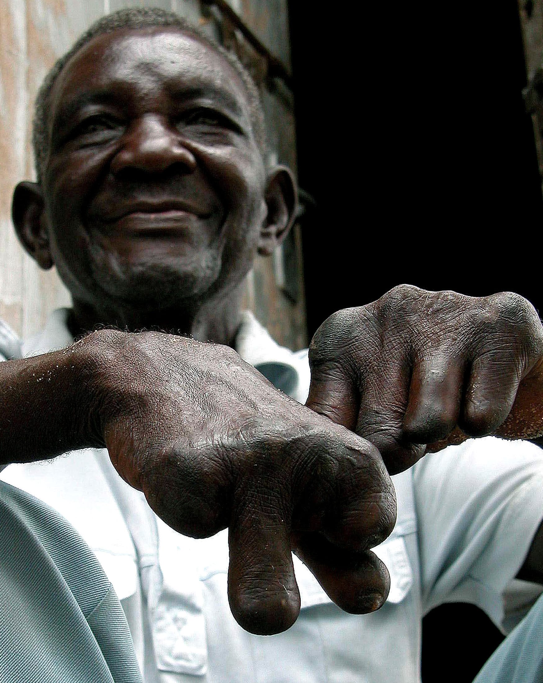 Rasmo Kirapa sits outside his room at the Nunge Centre, where people are treated for leprosy, in Dar es Salaam, Tanzania, on December 16, 2004.