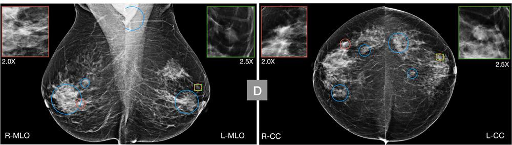 A radiologist judged this digital mammogram as inconclusive, leading to a unnecessary biopsy. In a study, an AI deemed the scan to be "nonsuspicious" and could have prevented the unnecessary care.