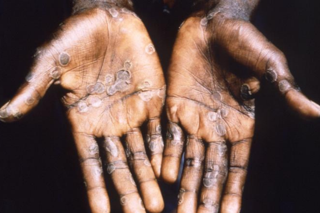 U.S. Monkeypox Case Contained
