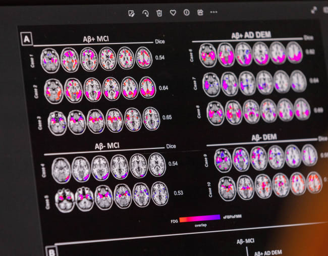 A scientist looks at hypometabolic and hypoperfusion patterns at the single-subject level from a patient with Alzheimer's disease at the Memory Centre, in Geneva, Switzerland, on June 6, 2023. 