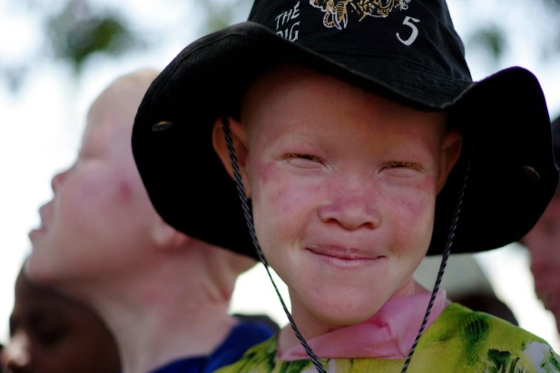 Under the Radar: People with Albinism in Eastern and Southern Africa