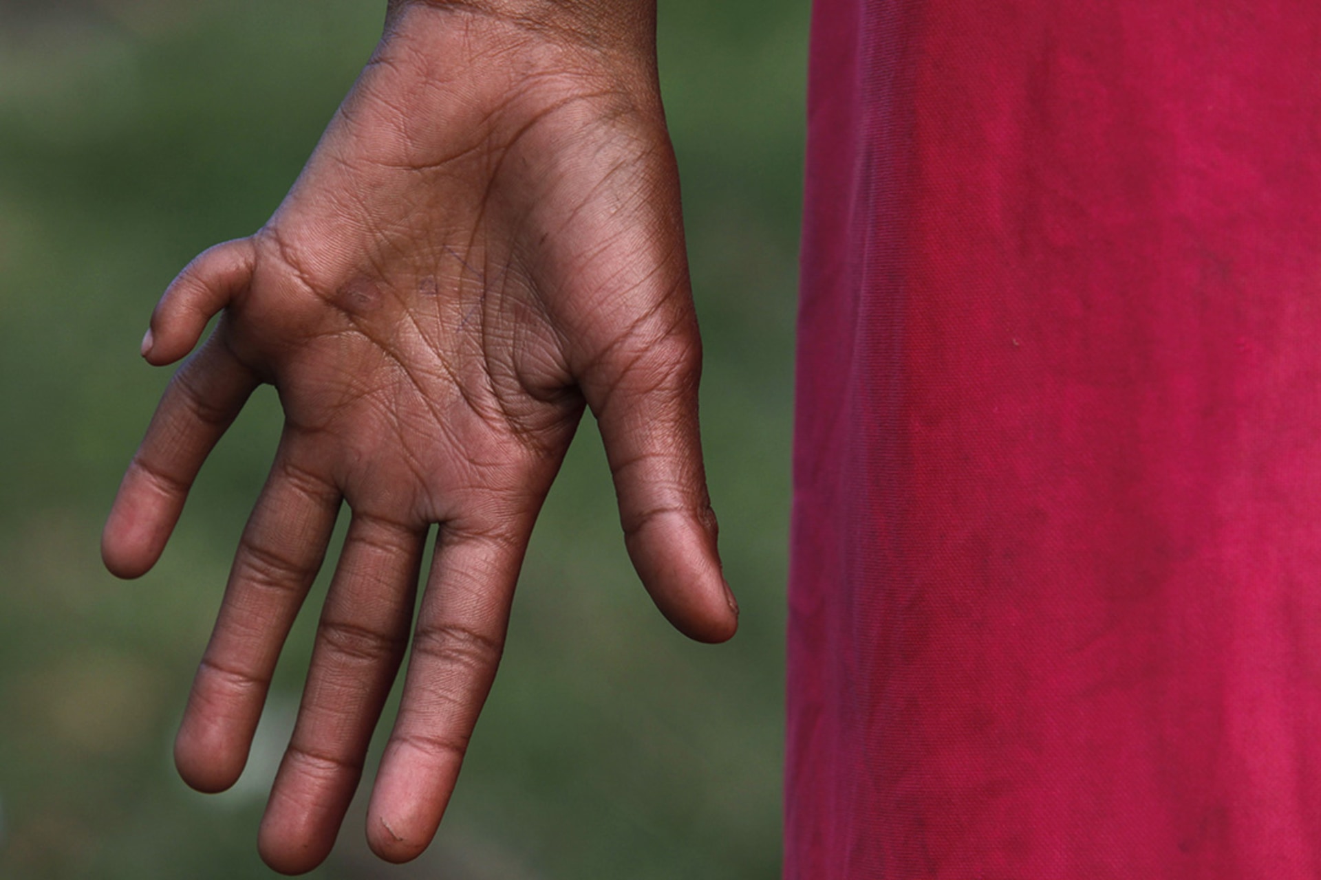 An eleven-year-old born with six fingers on both hands, which activists claim is evidence of birth defects caused by legacy pollution from Union Carbide’s pesticide plant in Bhopal. 