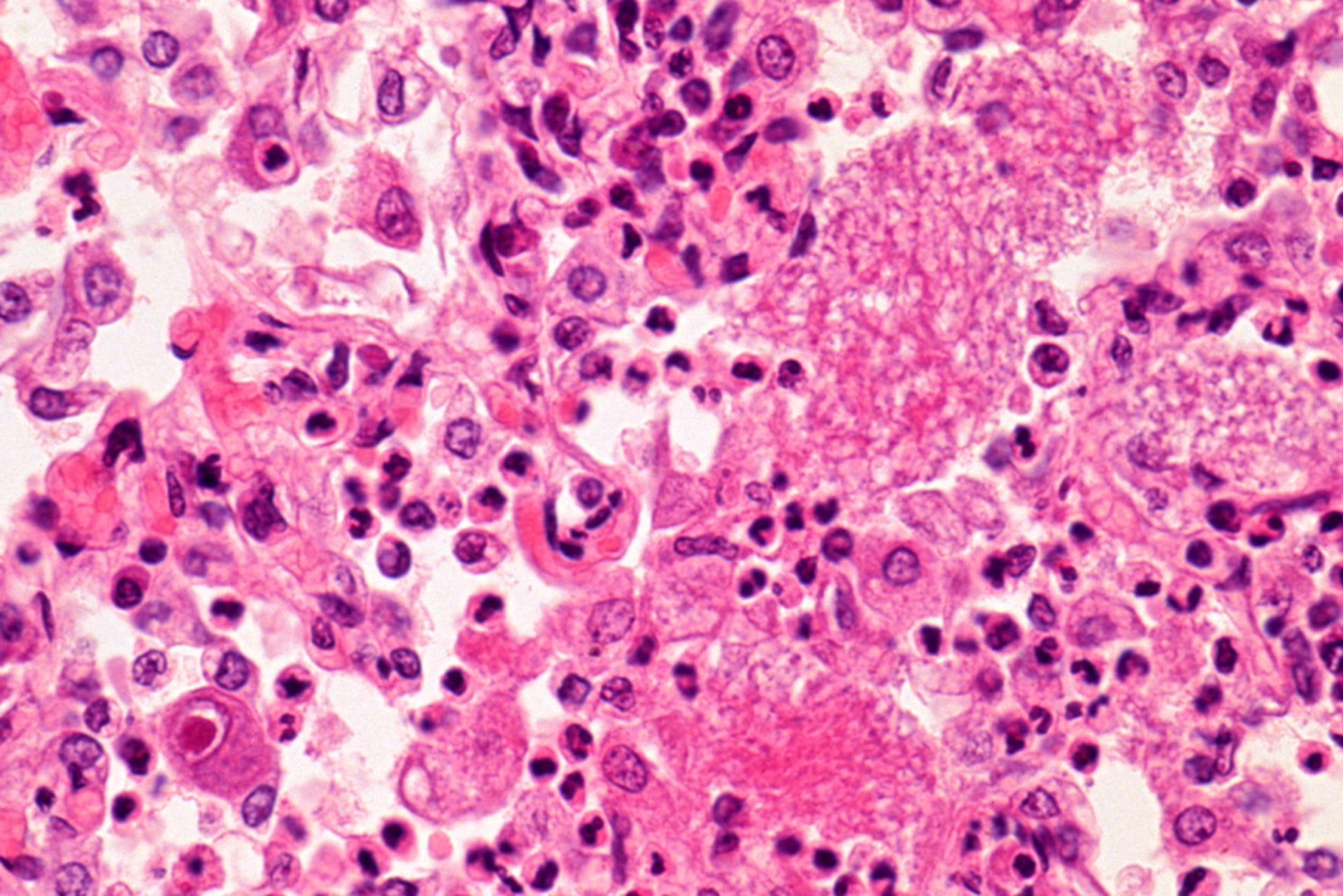 A microscopic image of a lung with pneumocystis pneumonia, the innocuous illness that became fatal in patients with HIV and alerted the CDC to the existence of AIDS.