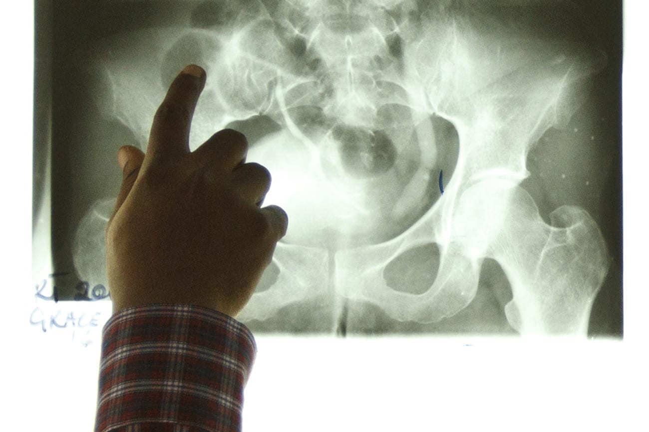 Radiotherapist Kofi Kyei, 30, points at a tumor on an X-ray from a patient suffering from bladder cancer, at the Korle Bu Teaching Hospital, in Accra, Ghana, on April 24, 2012. Most of Africa's around 2,000 languages have no word for cancer. The common perception in both developing and developed countries is that it's a disease of the wealthy world, where high-fat, processed-food diets, alcohol, smoking and sedentary lifestyles fuel tumour growth. Yet there are an estimated one million new cancer cases sub-Saharan Africa will see this year - a number predicted to double to 2 million a year in the next decade. Picture taken April 24, 2012. To match Insight CANCER-AFRICA/GHANA REUTERS/Olivier Asselin (GHANA - Tags: HEALTH SOCIETY)