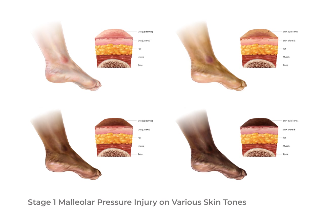 The following are four illustrations from my project, WoundWatch, depicting a stage 1 malleolar pressure injury across diverse skin tones.