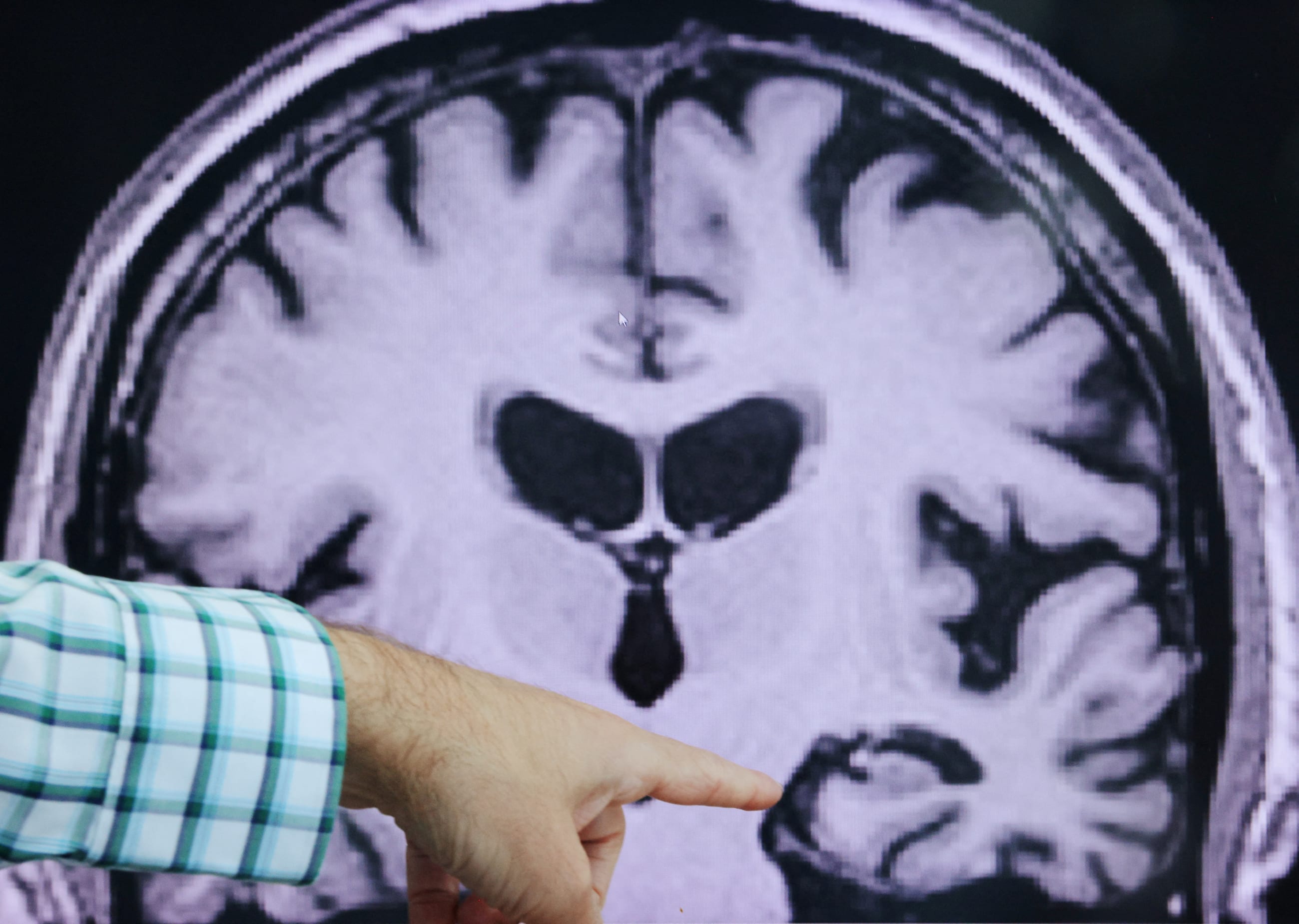 Dr. Seth Gale points out evidence of Alzheimer's disease on an MRI at the Center for Alzheimer Research and Treatment (CART) at Brigham And Women's Hospital in Boston, Massachusetts, U.S., March 30, 2023. REUTERS/Brian Snyder