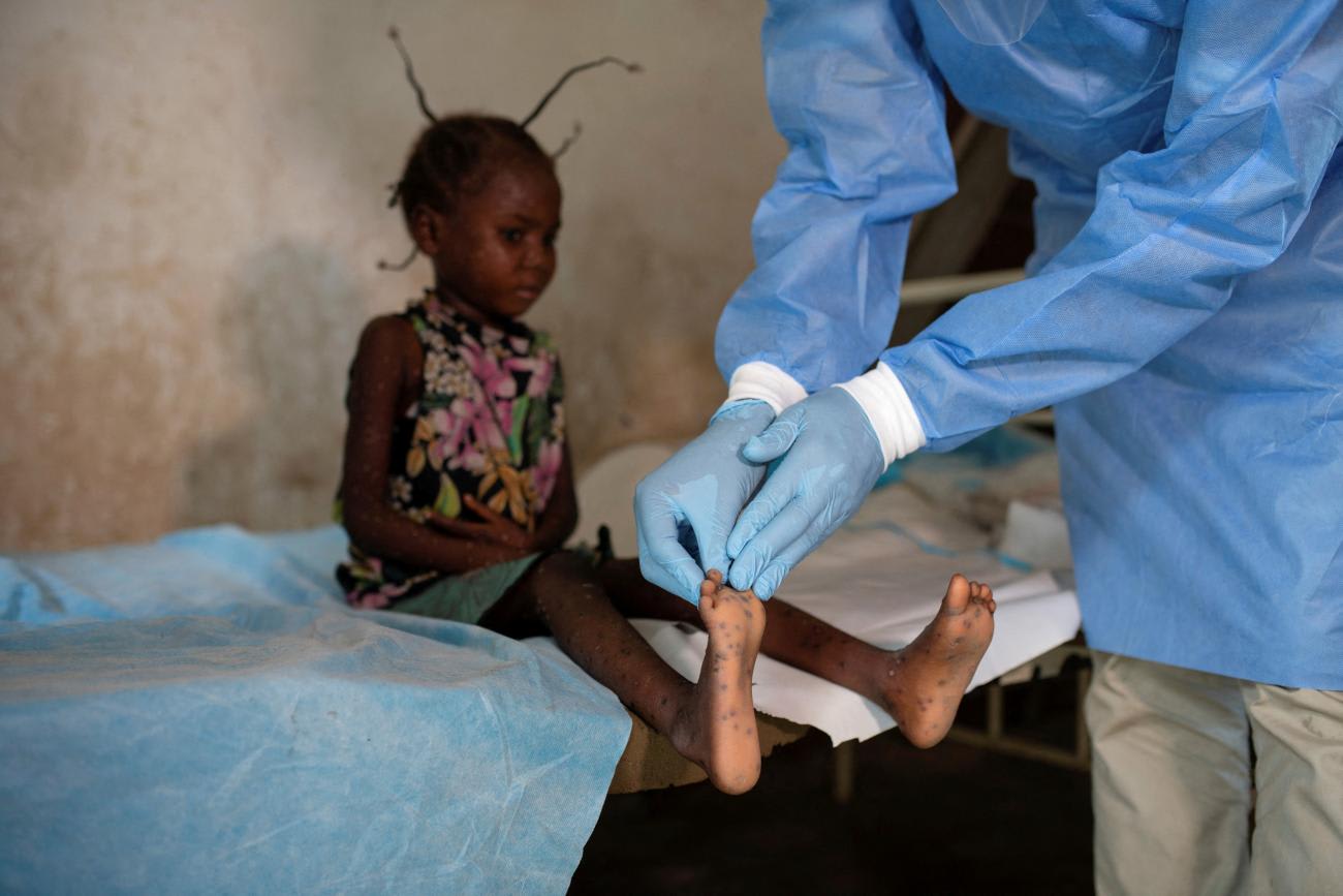 6-year-old has boils on her feet checked by a local health official, before he takes skin samples to test for mpox, at the Yalolia health centre, in Tshopo, Democratic Republic of Congo.