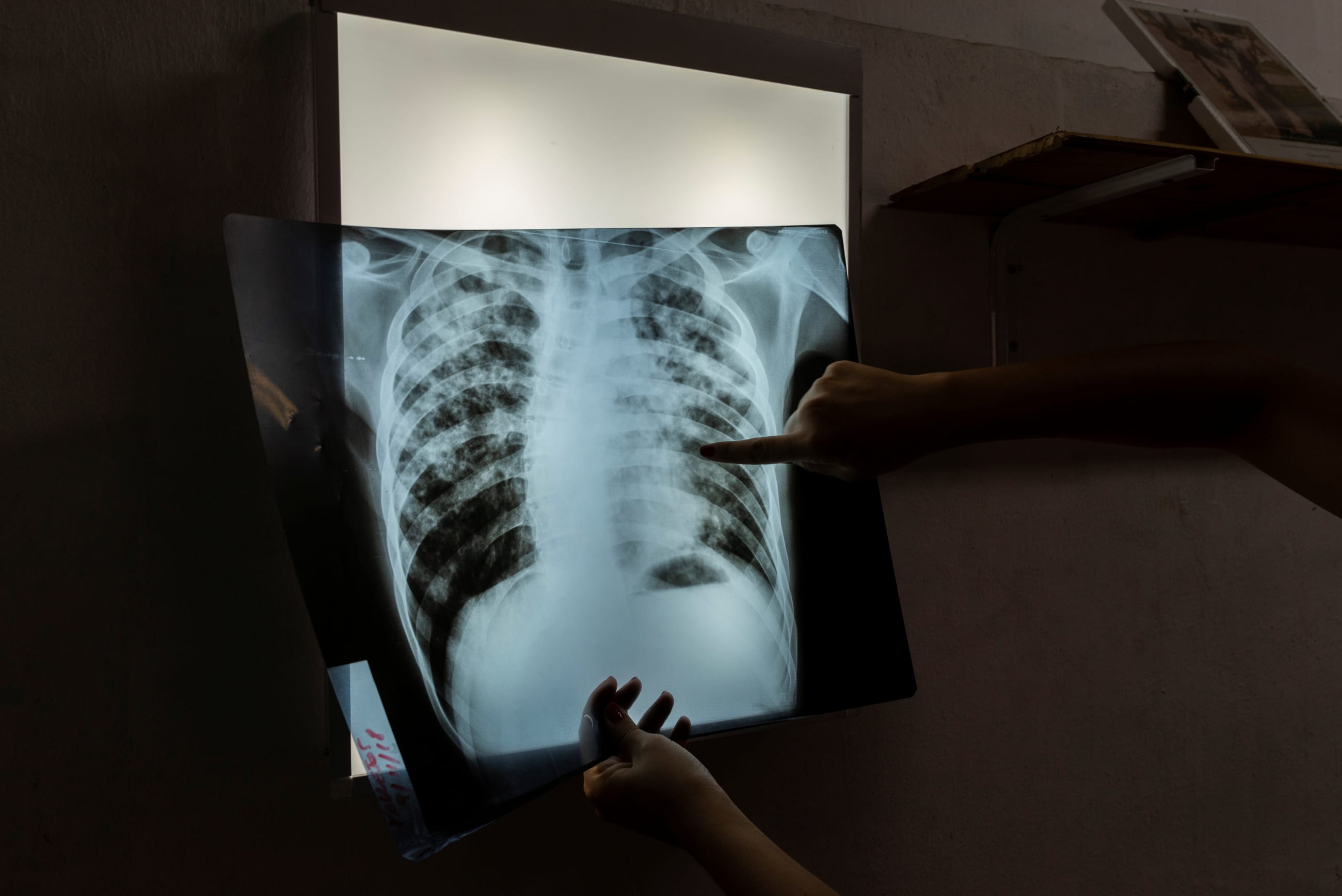 An infectious disease specialist intern analyzes an X-ray of 24-year-old patient undergoing treatment for TB in Buenos Aires, Argentina, on January 29, 2019.
