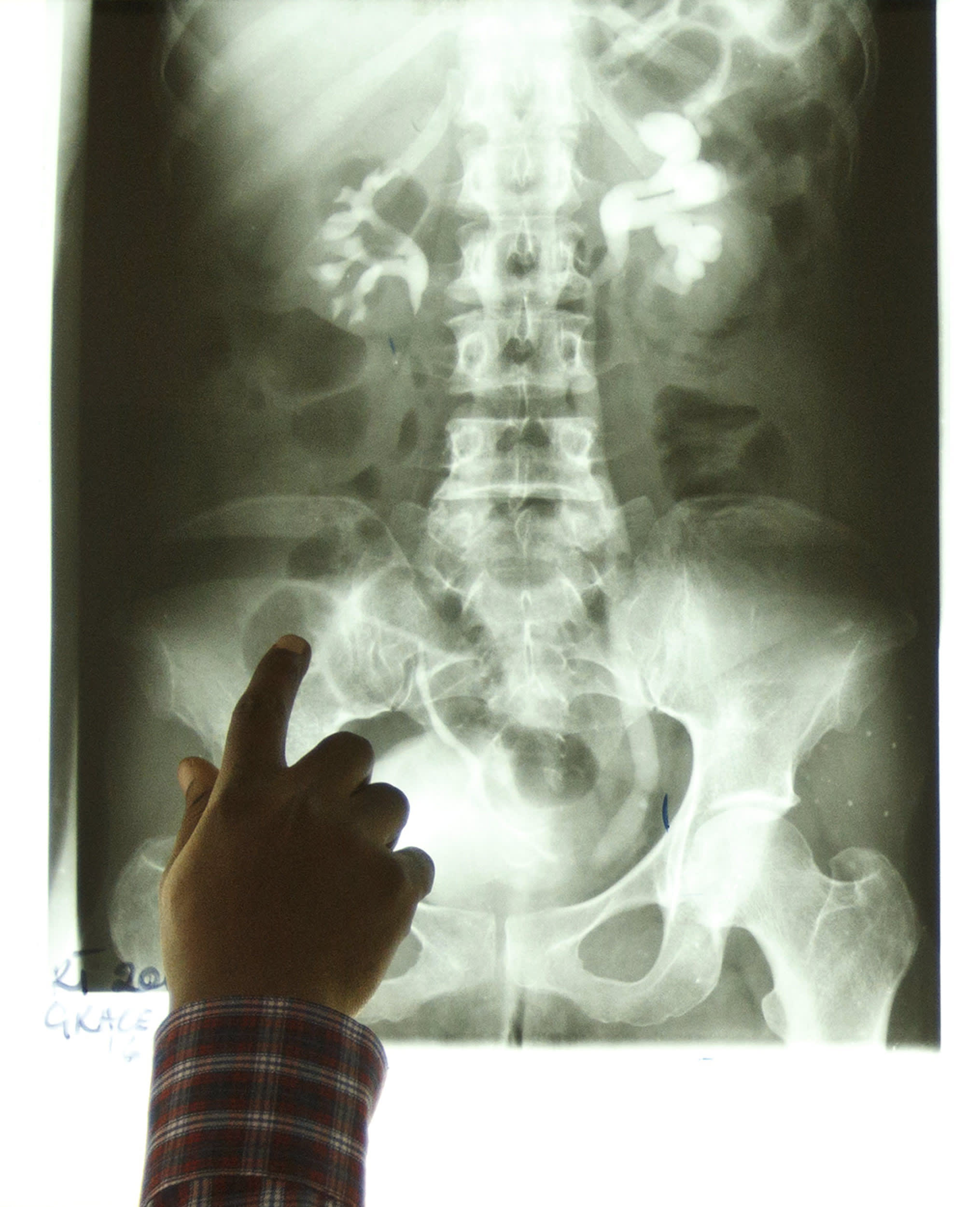 Radiotherapist Kofi Kyei, 30, points at a tumor on an X-ray from a patient suffering from bladder cancer, at the Korle Bu Teaching Hospital, in Accra, Ghana, on April 24, 2012. Most of Africa's around 2,000 languages have no word for cancer. The common perception in both developing and developed countries is that it's a disease of the wealthy world, where high-fat, processed-food diets, alcohol, smoking and sedentary lifestyles fuel tumour growth. Yet there are an estimated one million new cancer cases sub-Saharan Africa will see this year - a number predicted to double to 2 million a year in the next decade. Picture taken April 24, 2012. To match Insight CANCER-AFRICA/GHANA REUTERS/Olivier Asselin (GHANA - Tags: HEALTH SOCIETY)