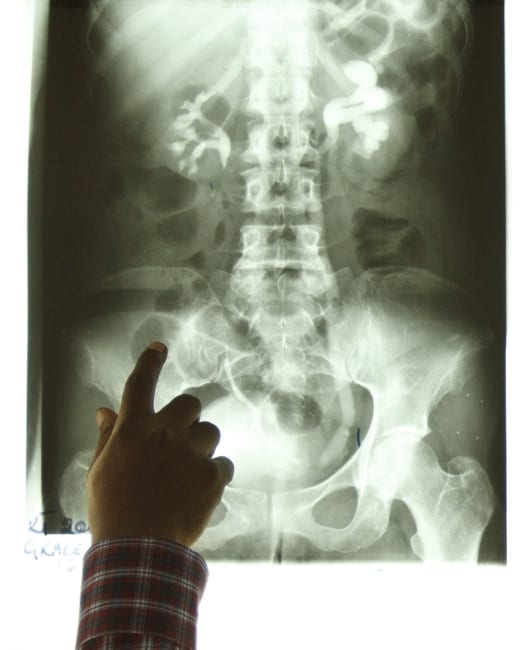 Radiotherapist Kofi Kyei, 30, points at a tumor on an X-ray from a patient suffering from bladder cancer, at the Korle Bu Teaching Hospital, in Accra, Ghana, on April 24, 2012. Most of Africa's around 2,000 languages have no word for cancer. The common perception in both developing and developed countries is that it's a disease of the wealthy world, where high-fat, processed-food diets, alcohol, smoking and sedentary lifestyles fuel tumour growth. Yet there are an estimated one million new cancer cases sub-Saharan Africa will see this year - a number predicted to double to 2 million a year in the next decade. Picture taken April 24, 2012. To match Insight CANCER-AFRICA/GHANA REUTERS/Olivier Asselin (GHANA - Tags: HEALTH SOCIETY)