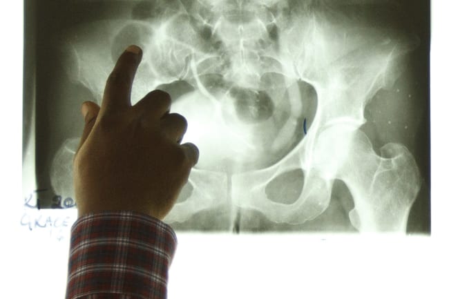 Radiotherapist Kofi Kyei, 30, points at a tumor on an X-ray from a patient suffering from bladder cancer, at the Korle Bu Teaching Hospital, in Accra, Ghana, on April 24, 2012. Most of Africa's around 2,000 languages have no word for cancer. The common perception in both developing and developed countries is that it's a disease of the wealthy world, where high-fat, processed-food diets, alcohol, smoking and sedentary lifestyles fuel tumour growth. Yet there are an estimated one million new cancer cases sub-Saharan Africa will see this year - a number predicted to double to 2 million a year in the next decade. Picture taken April 24, 2012. To match Insight CANCER-AFRICA/GHANA REUTERS/Olivier Asselin (GHANA - Tags: HEALTH SOCIETY)