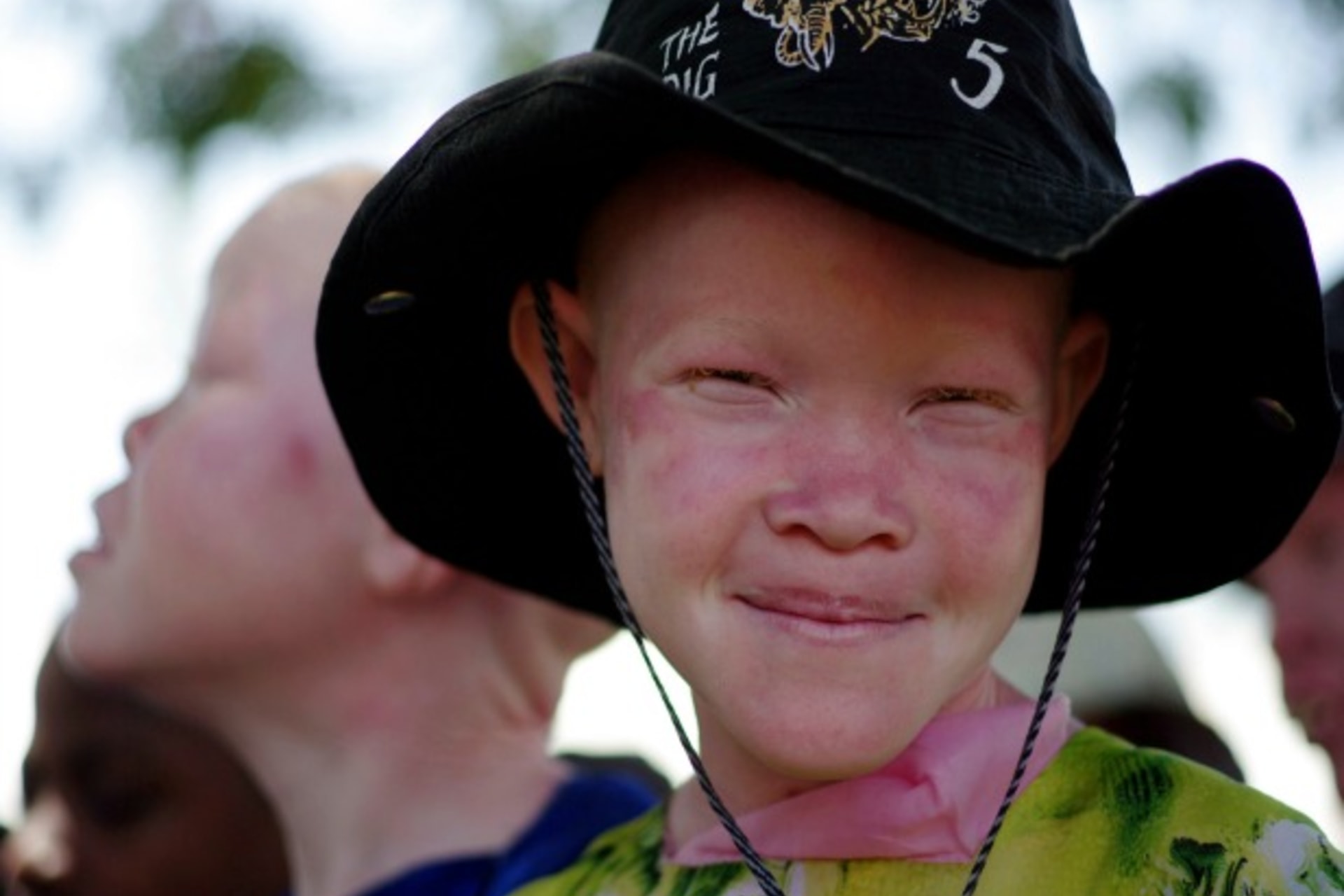 Under the Radar: People with Albinism in Eastern and Southern Africa